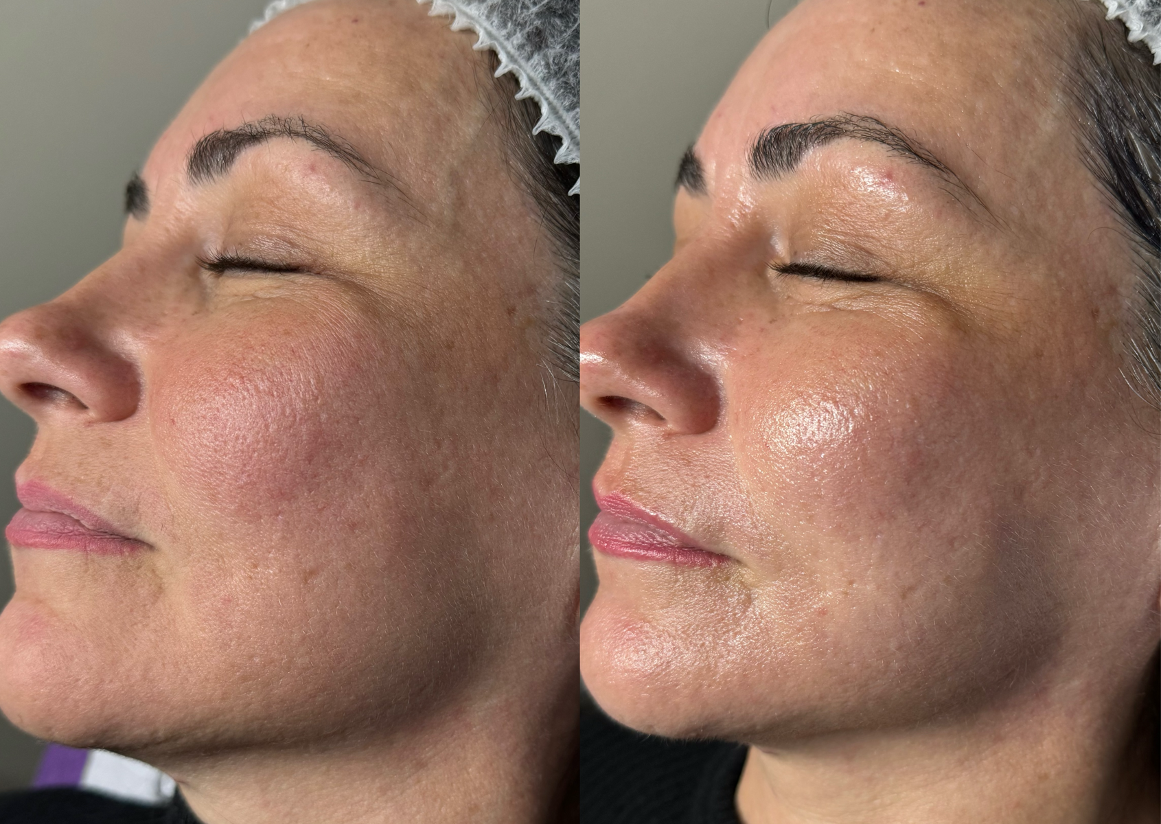 Jessner Medipeel (12% glycolic, lactic & kojic acid)