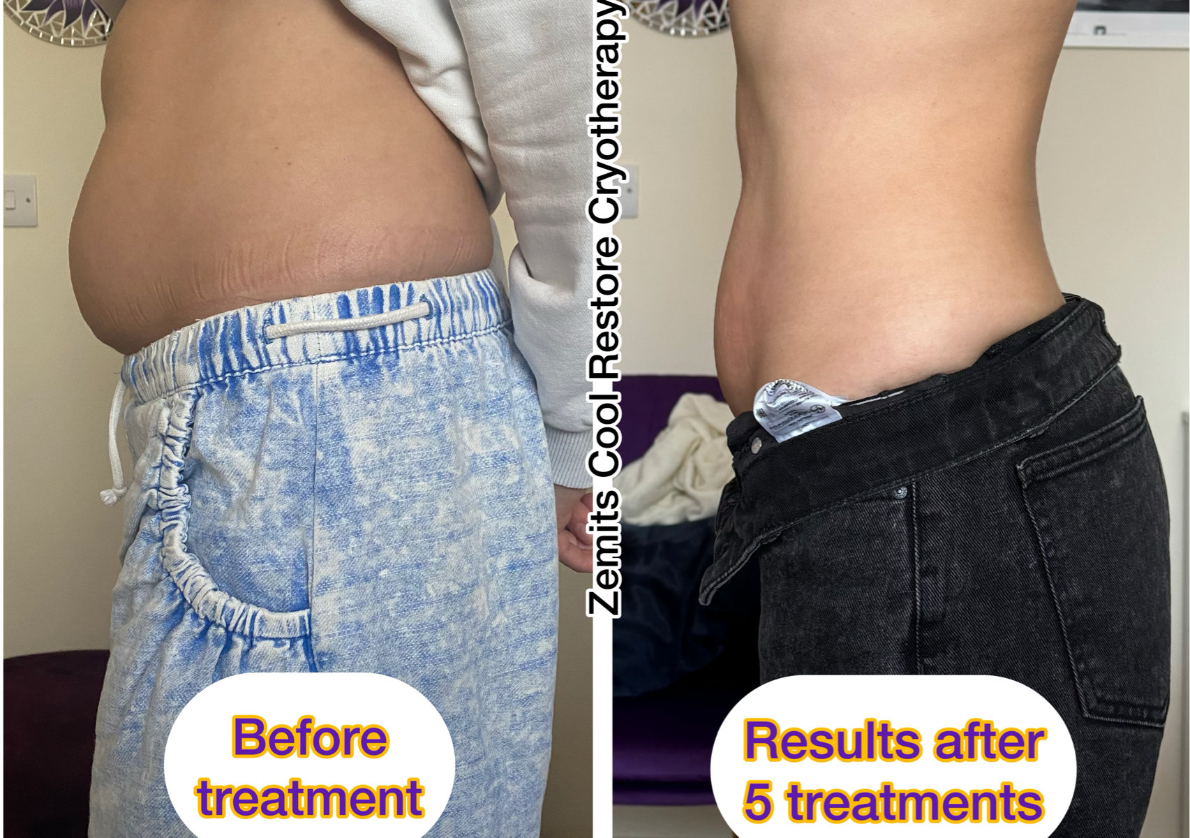 Cryotherapy (body slimming therapy & lymphatic drainage massage) - arms, abdomen, waist, thighs, bottom, bra line (price/area)