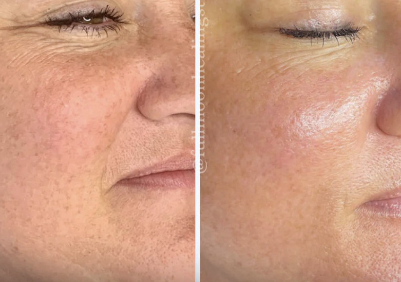 OxiPulse Facial