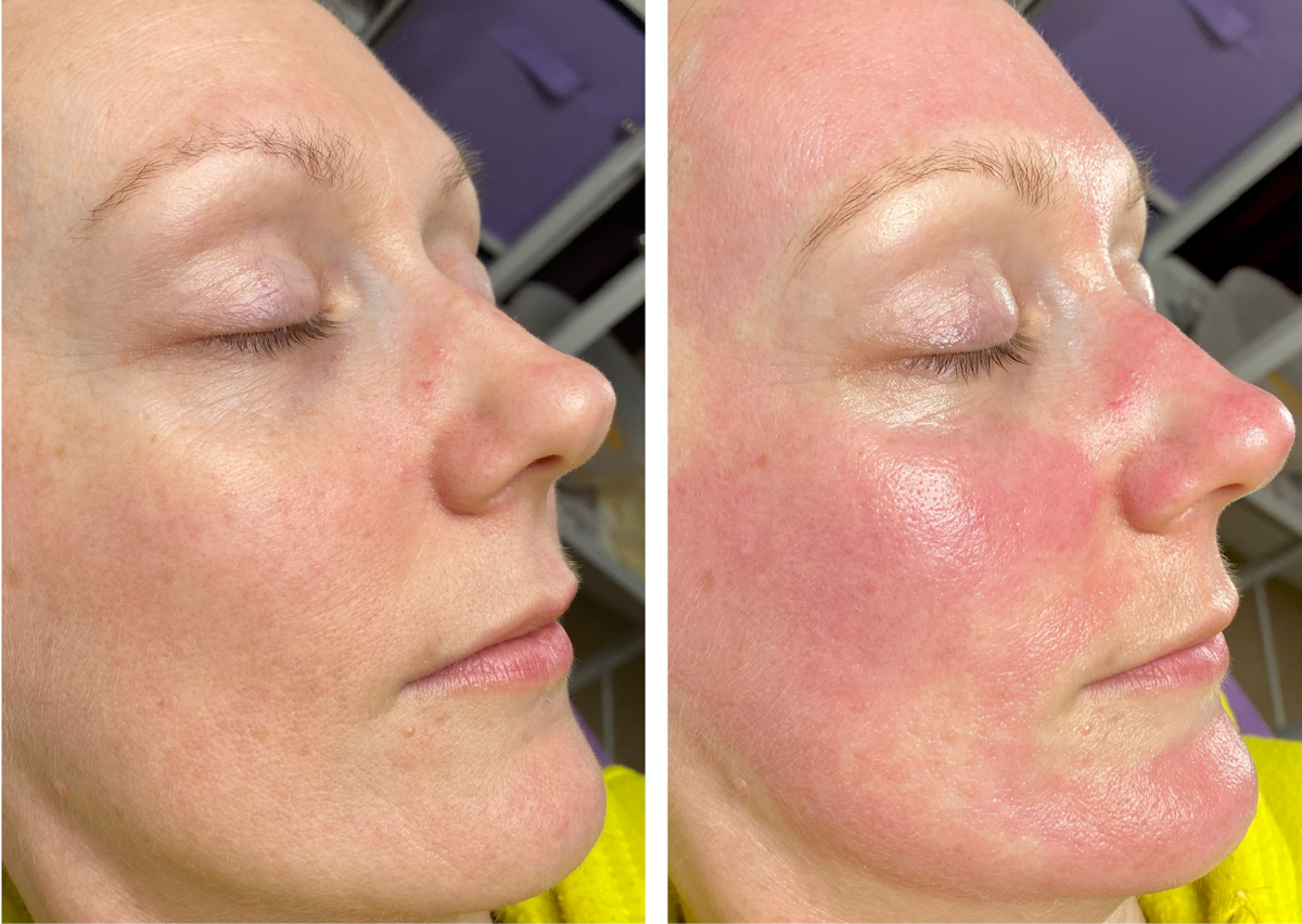 MediMD Deluxe Microneedling