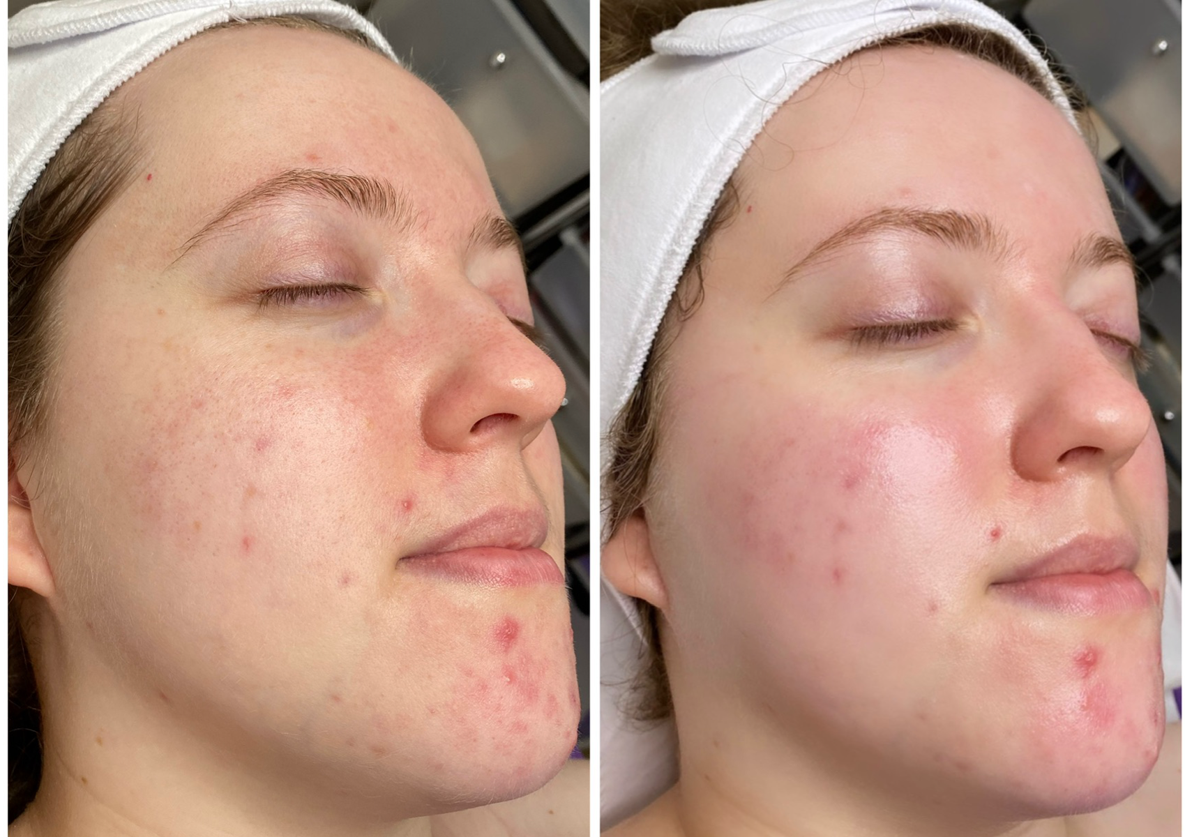 Anti Acne Facial
