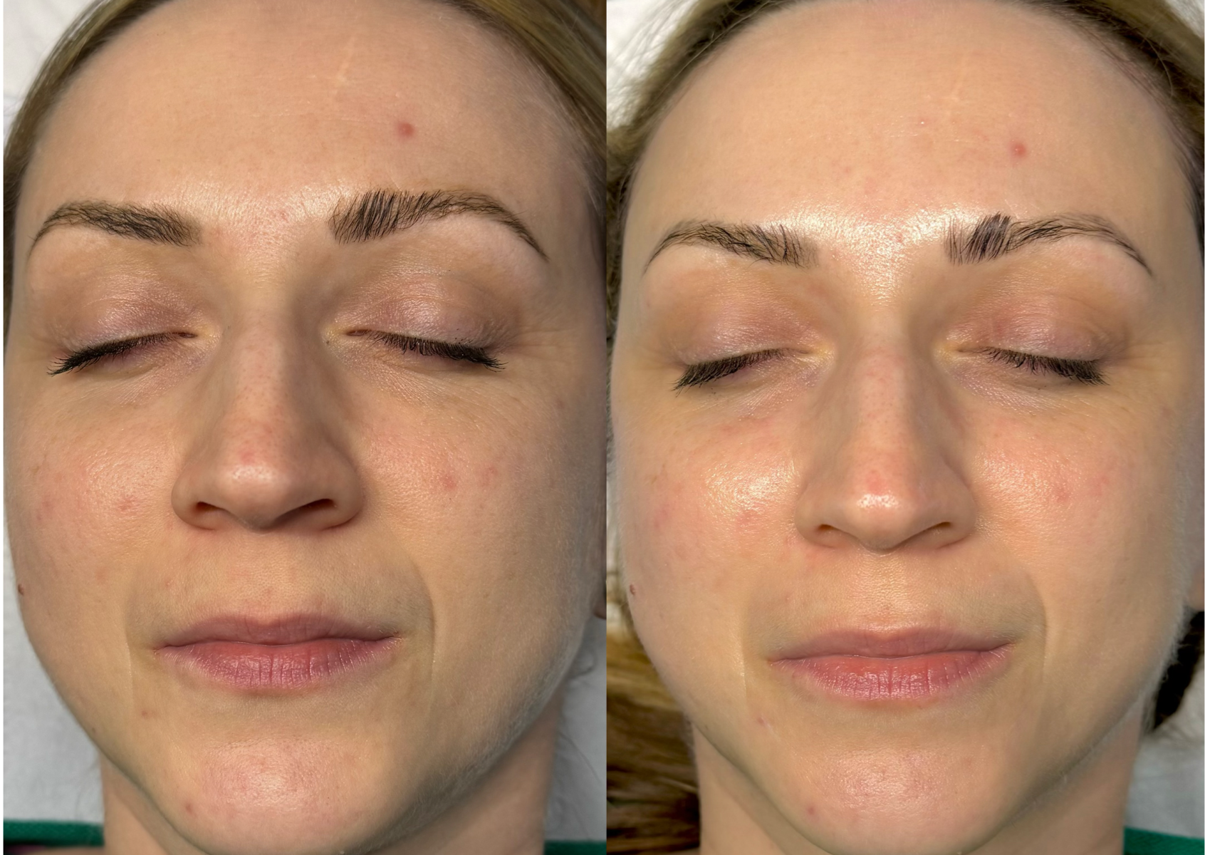 Rejuvenating Medipeel (lactic acid 20% & 50%)
