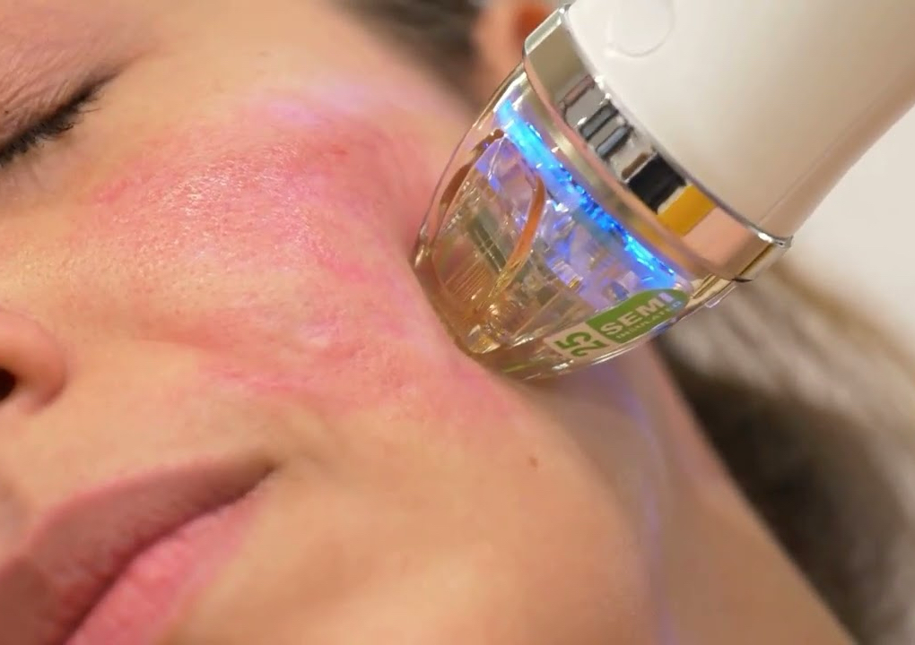 Microagujas con Radiofrecuencia fraccionada 