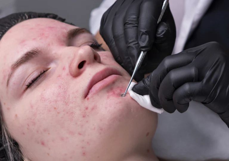 Acne Clarifying Facial 