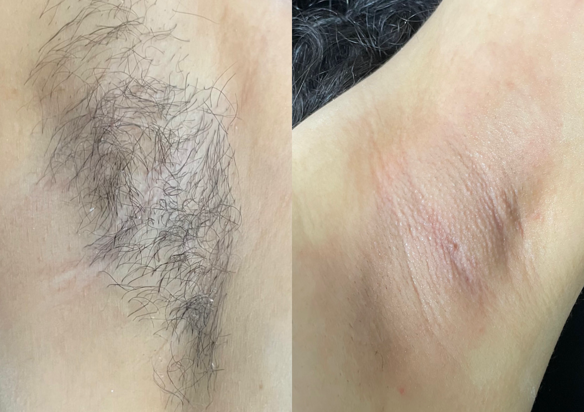 Depilación de axilas 