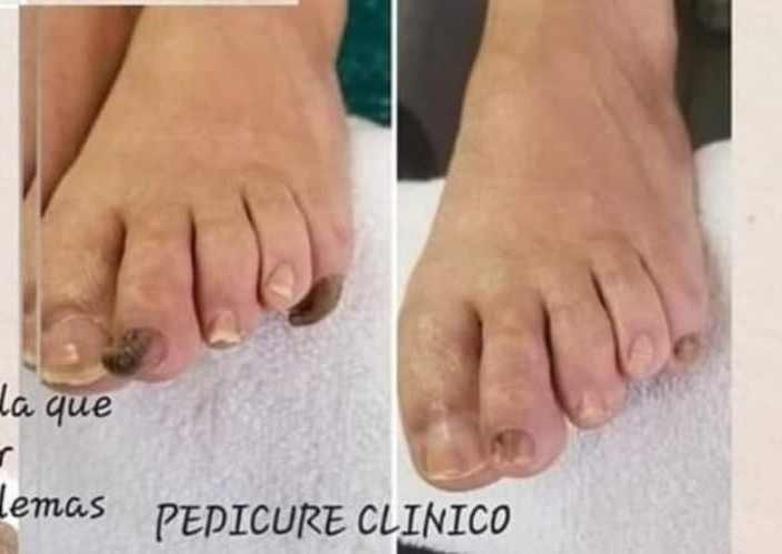 spa pedicure  preventivo