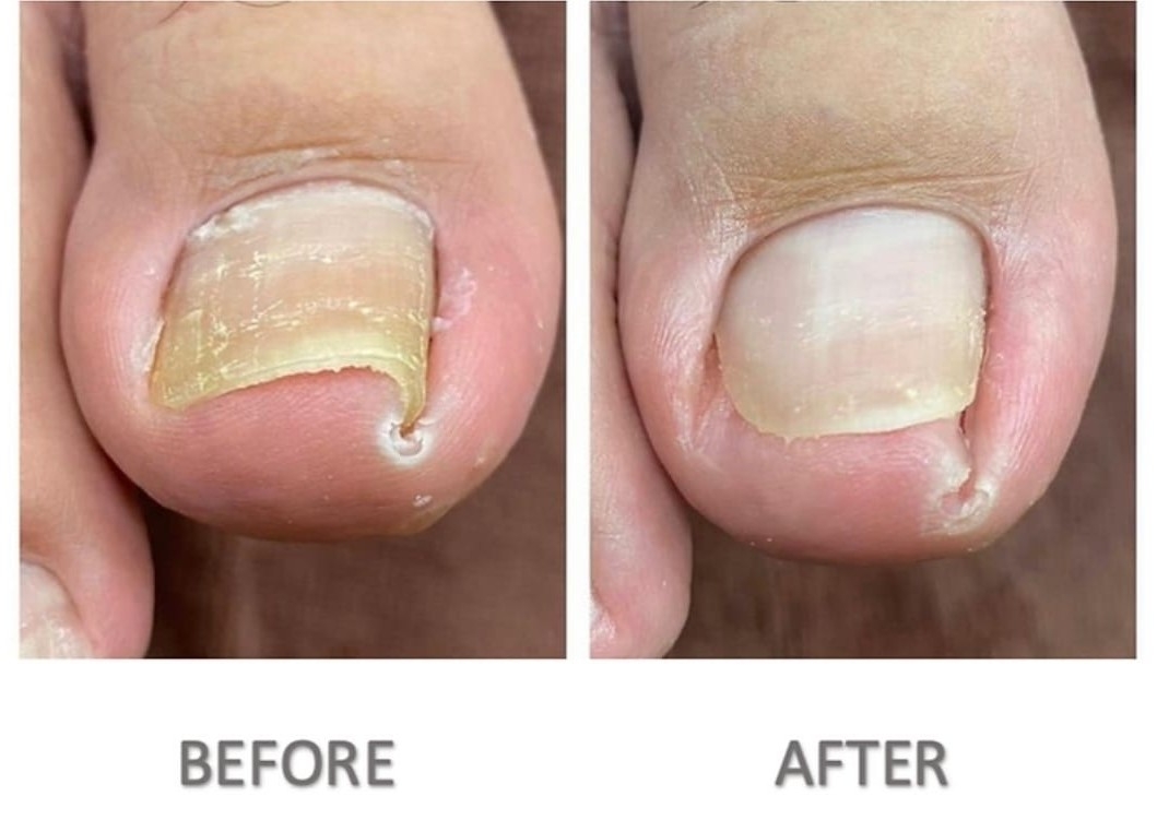 Uña encarnada  (ingrown nail)  emergencia 505.316.14.27  