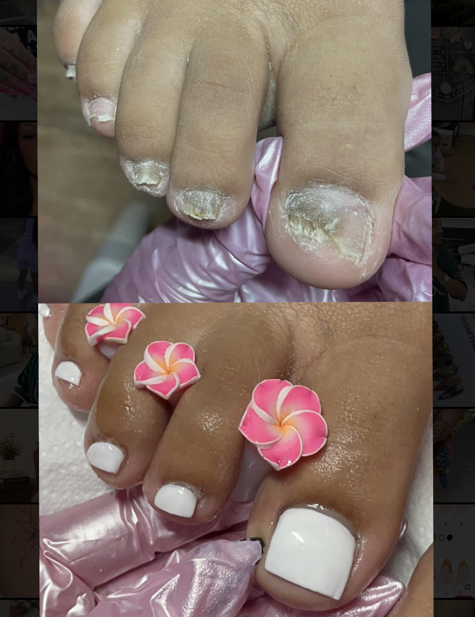 FUNGAL Toe Reconstruction 