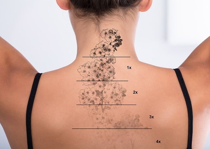 LASER TATTOO REMOVAL 