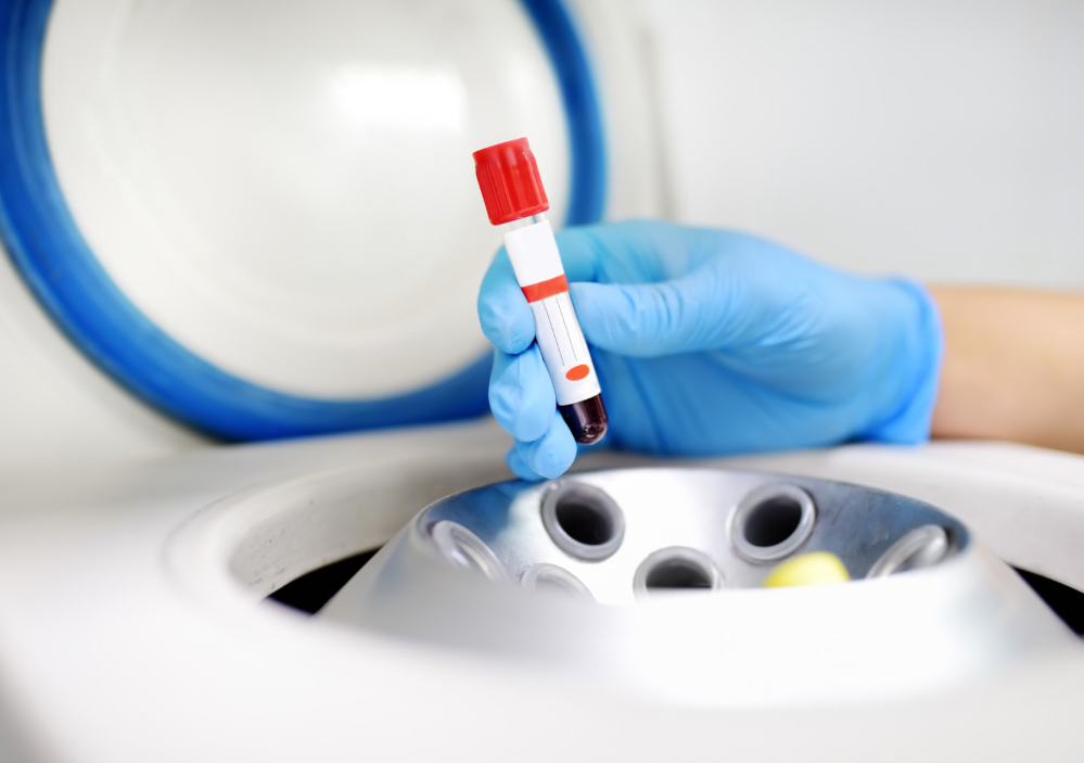 PRP Facial