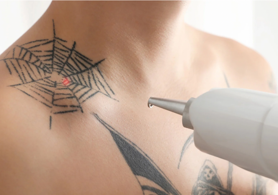 Picolaser Remoción Tatuaje Grande
