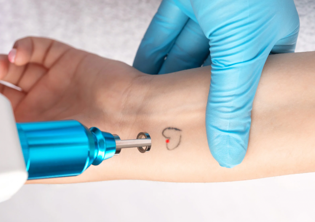 Picolaser Remoción Tatuaje Pequeño