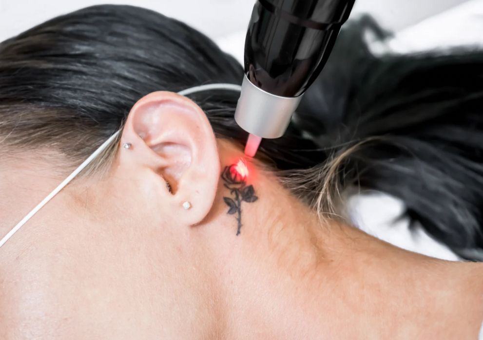 Picolaser Remoción Tatuaje Mediano