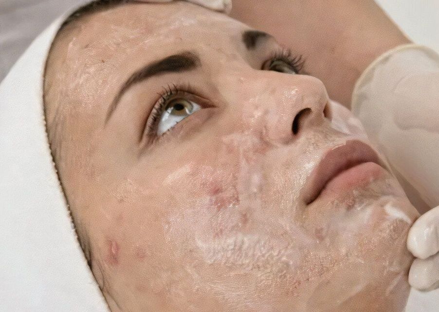 Clear Skin Acne Facial