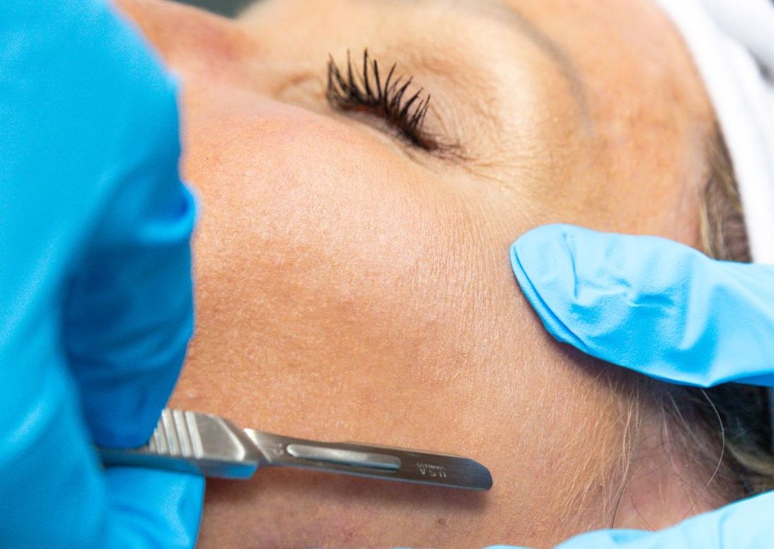 Dermaplaning with Oxygen Veil