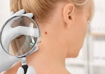 Eliminacion de lunar X1