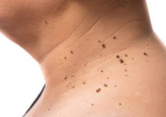 Eliminacion de acrocordones