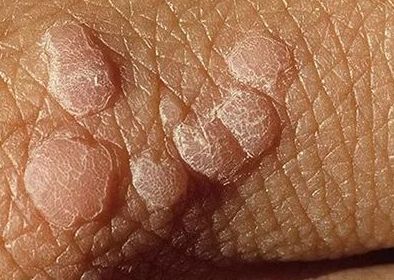 Eliminacion de verrugas en genitales