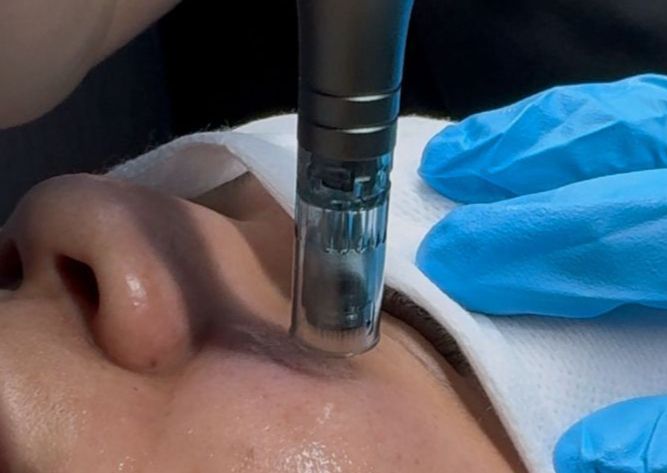 LIMPIEZA FACIAL + DERMAPEN