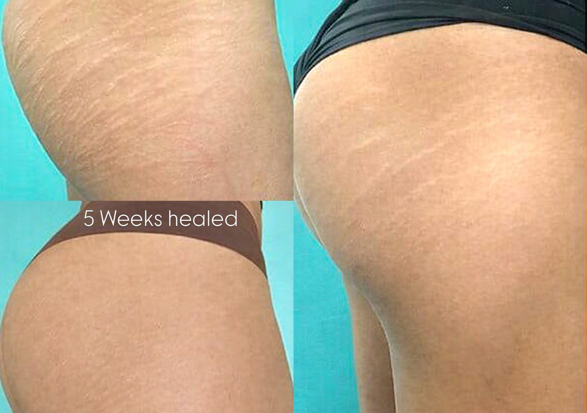 Stretch Marks Camouflage tattoo