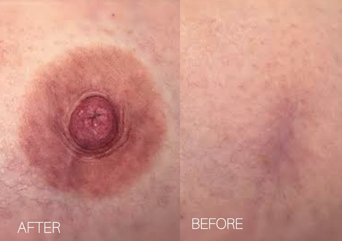 Areola & nipple restoration