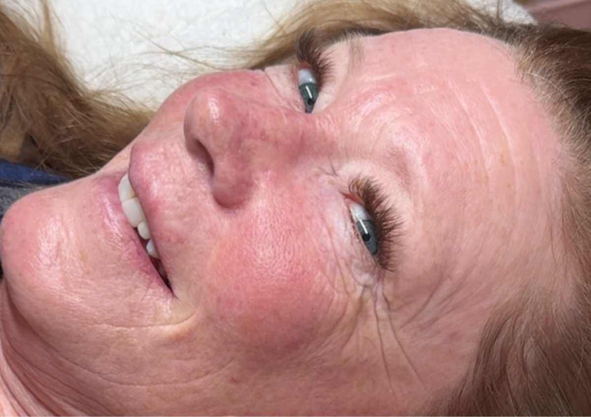 Micronedeling facial 