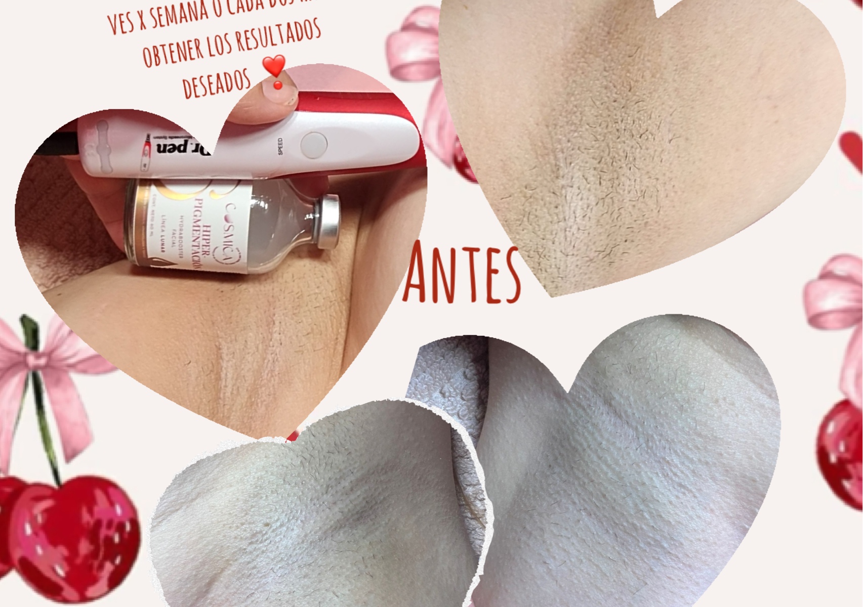 Armpit depigmenting (aclaracion de axila )