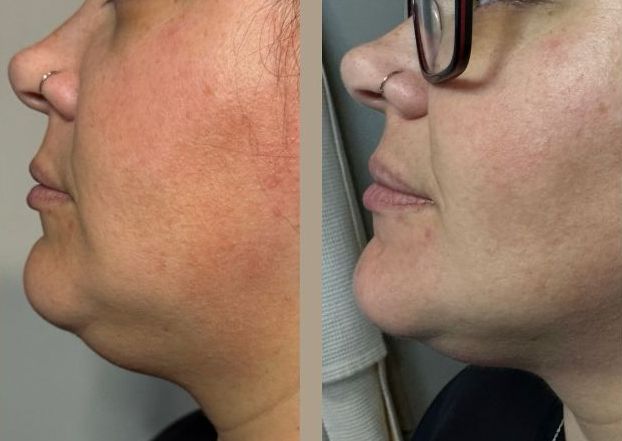 Double Chin Reduction