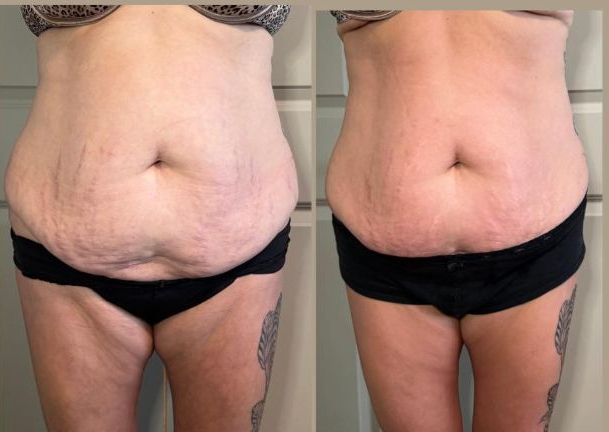 Waist Slimming