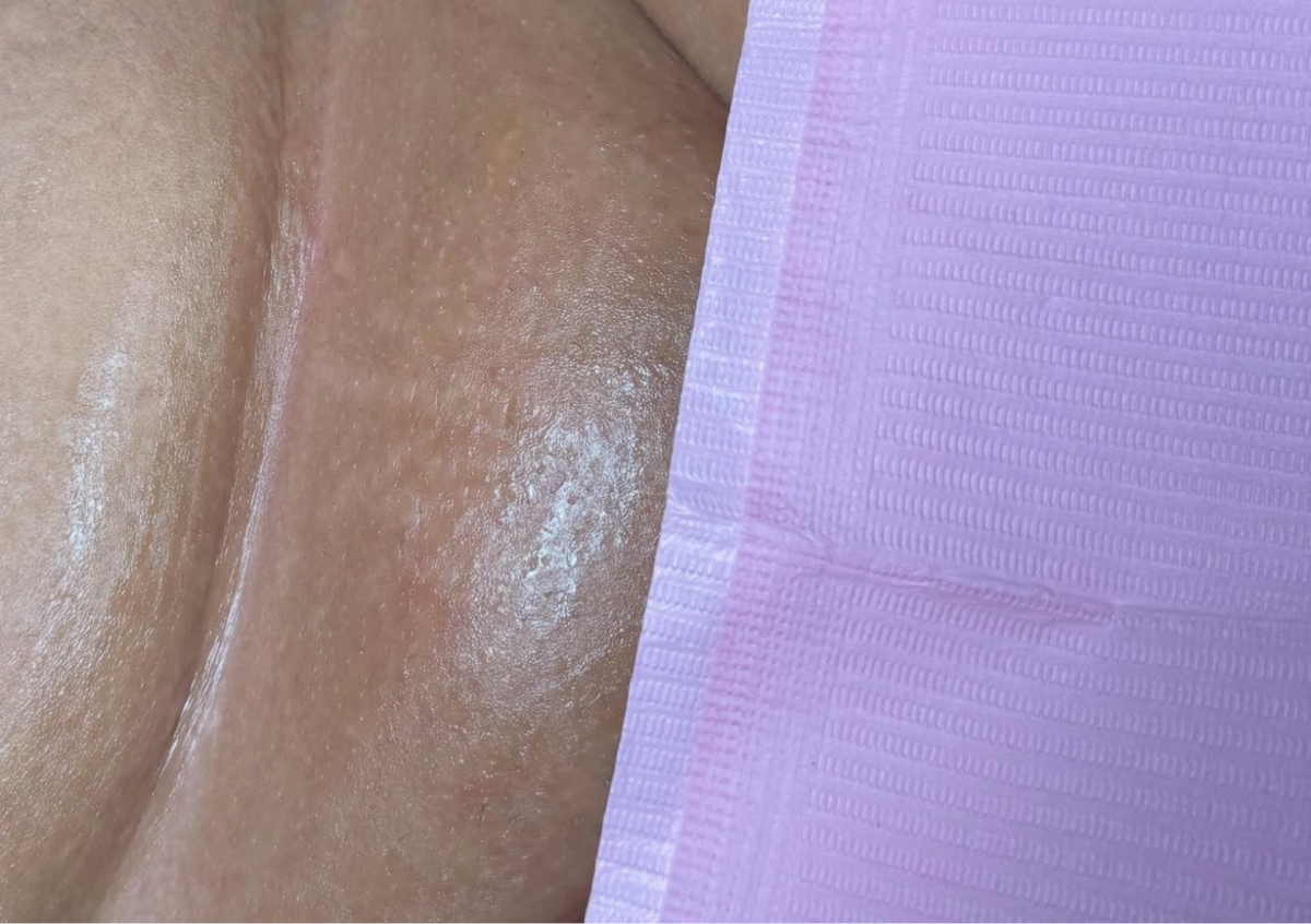 Brazilian wax
