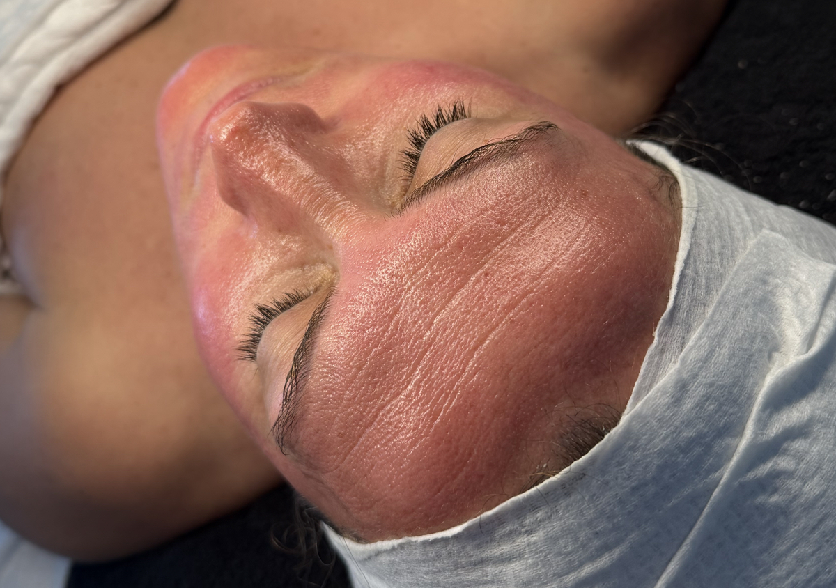 Mesotherapy