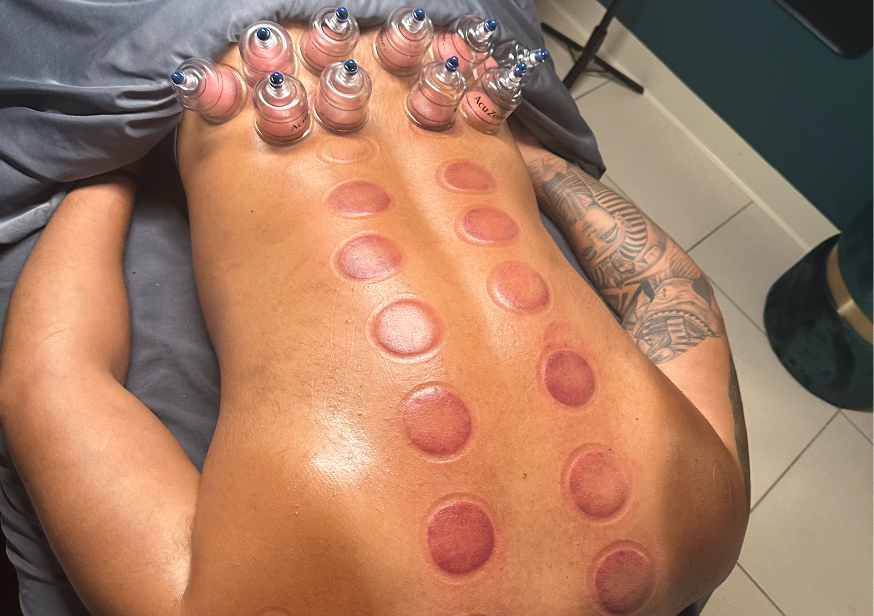 Cupping