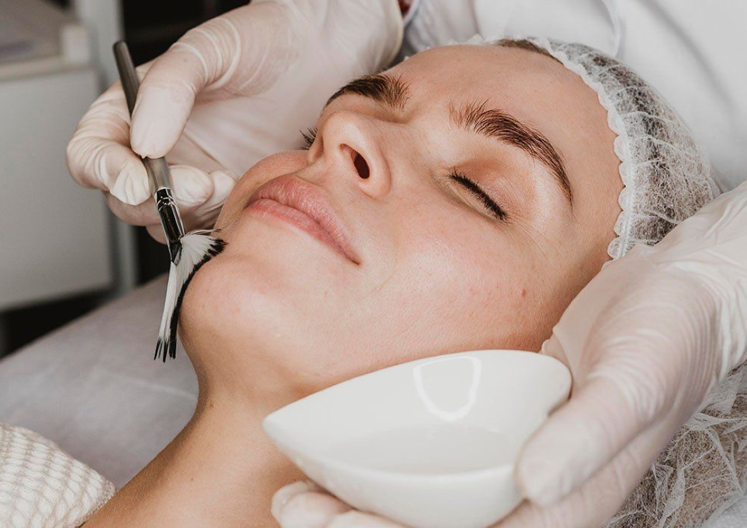 Facial con Ácidos