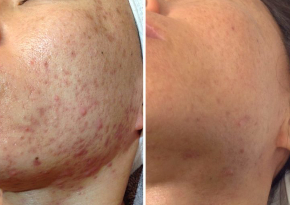 6- week Acne Program 