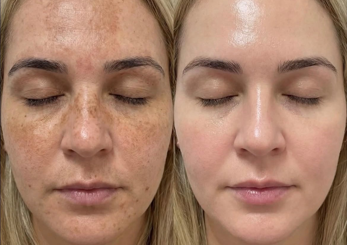 Cosmelan® Depigmentation Program