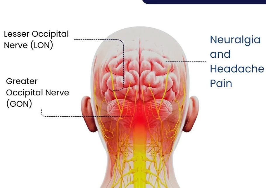 Botox for Occipital Neuralgia