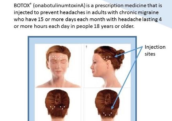 Botox for Headaches