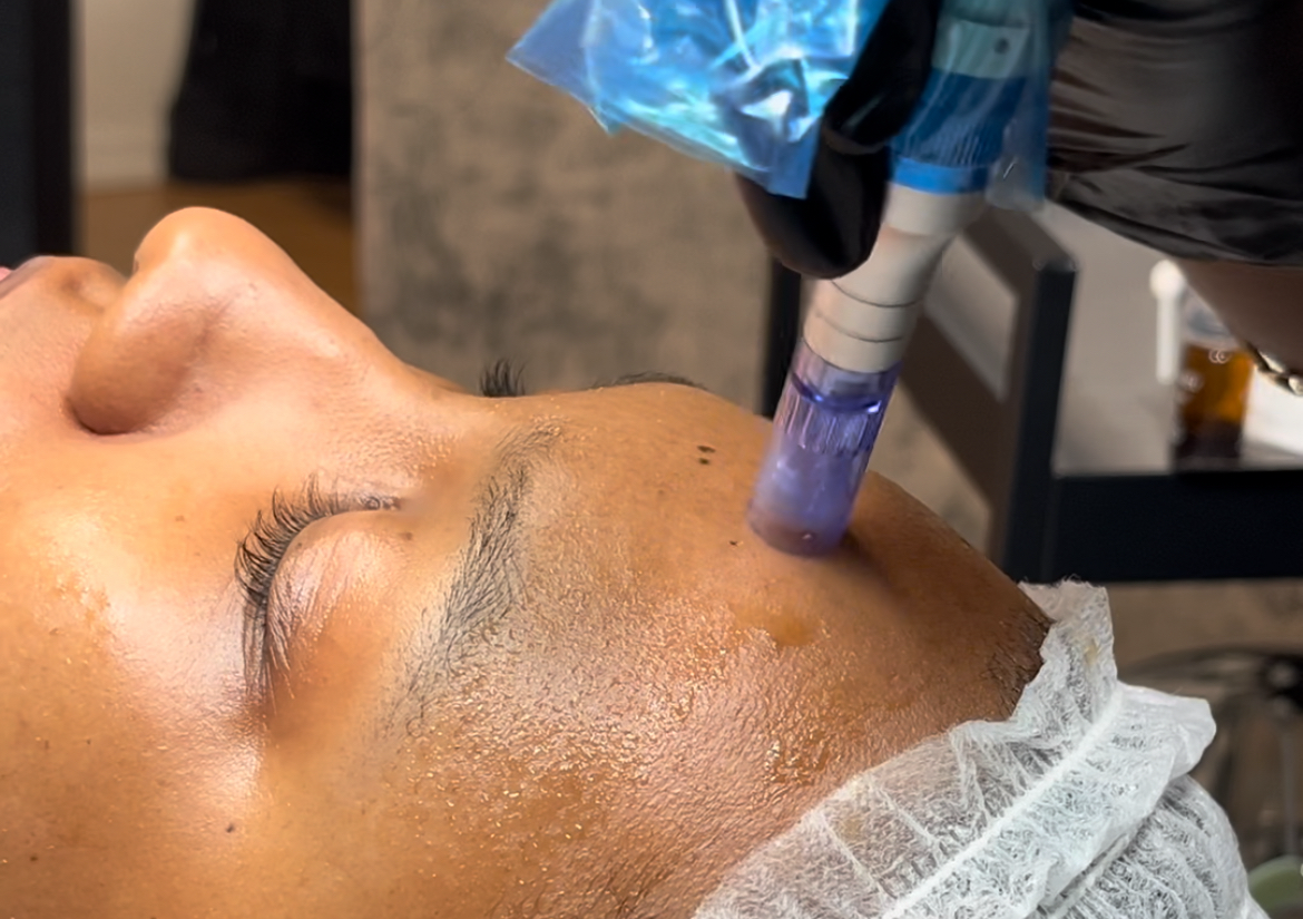 Traitement microneedling