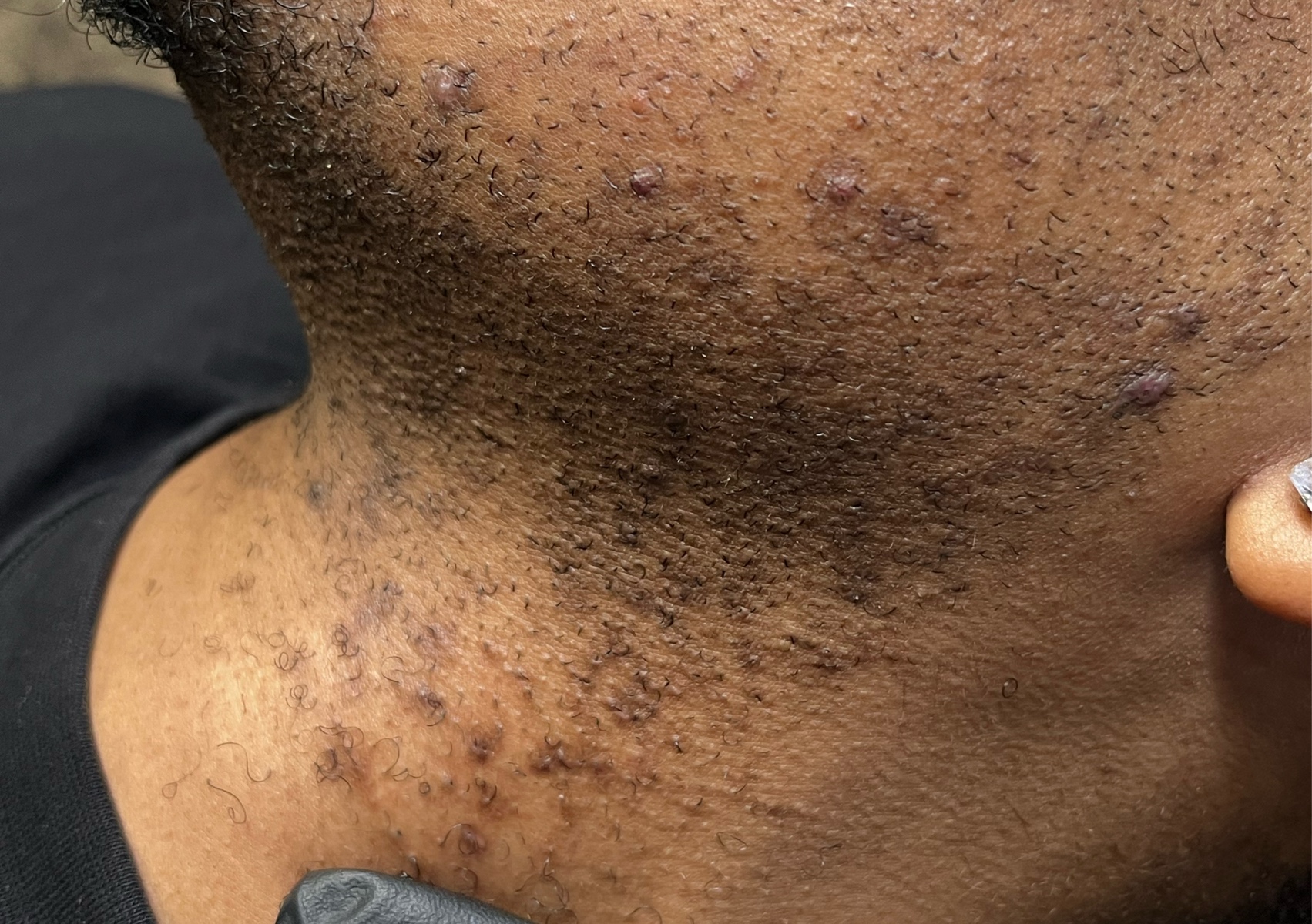 Poils incarnés | Ingrowns hair treatment 