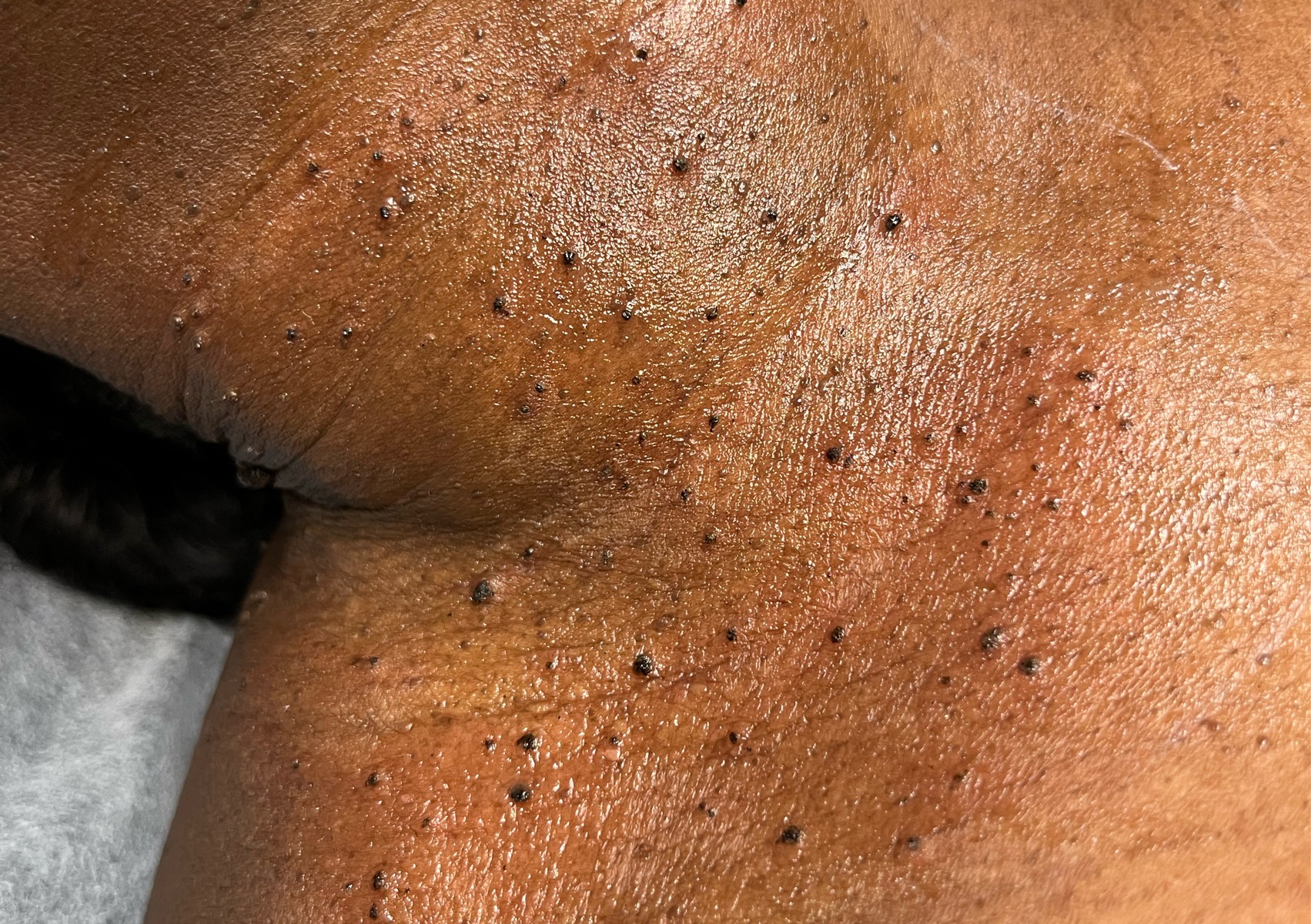 Skin tag | 2 zones | 1h 