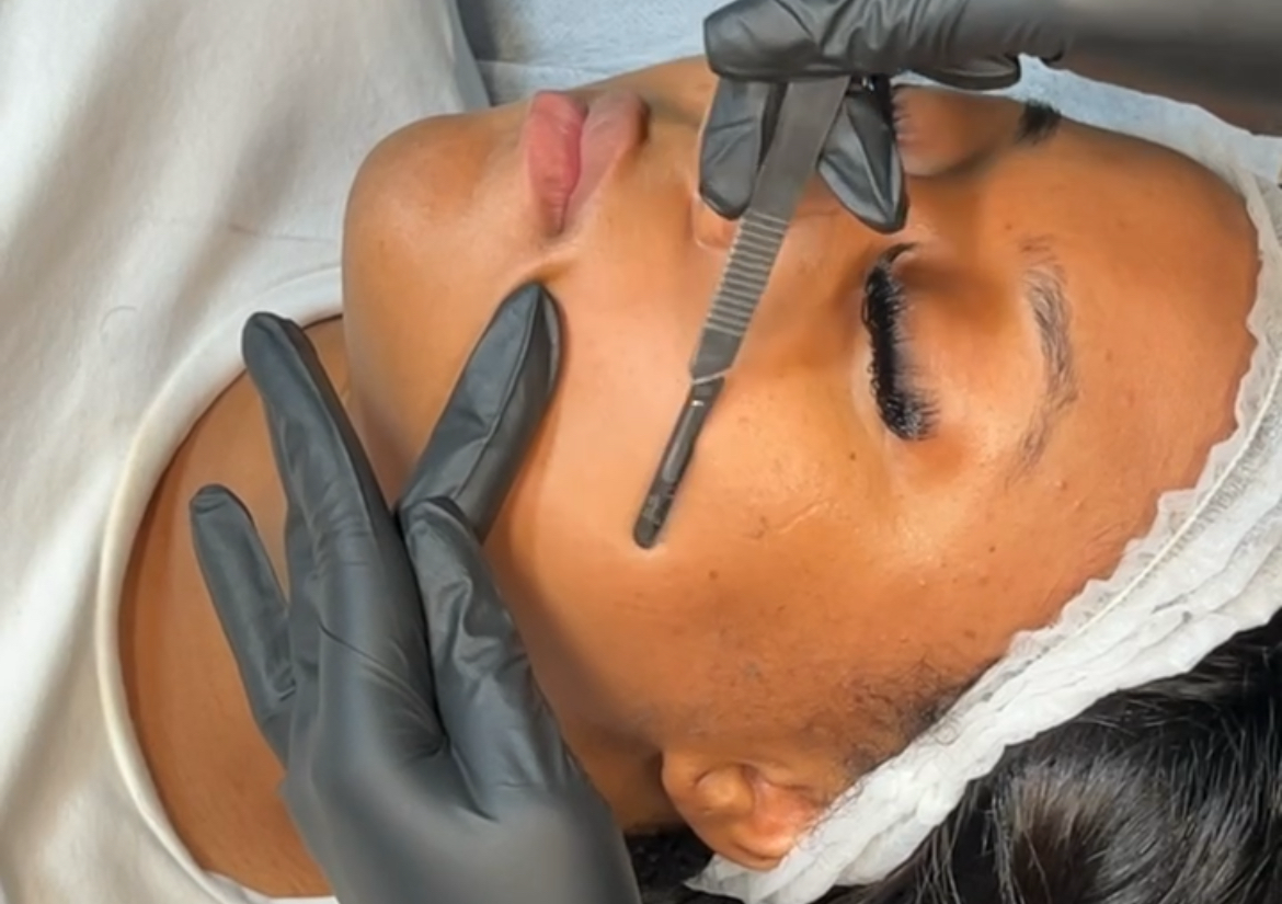 Dermaplaning