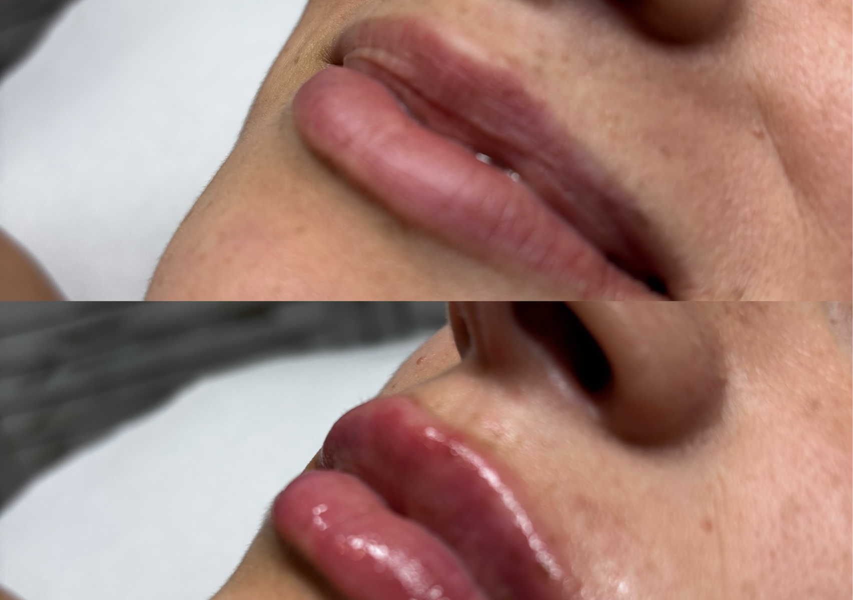 Lip filler with collagen and hyaluronic acid 