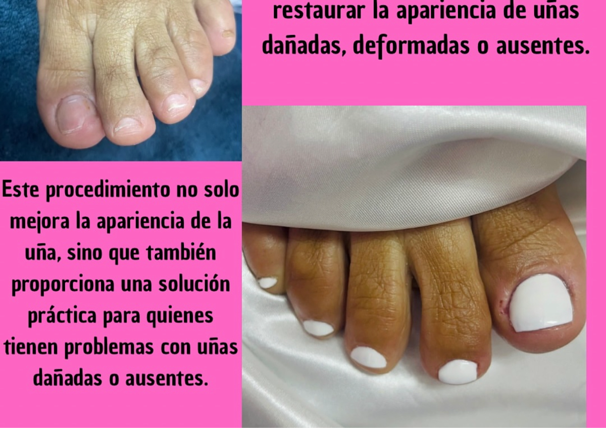 Reconstrucción de uña pies