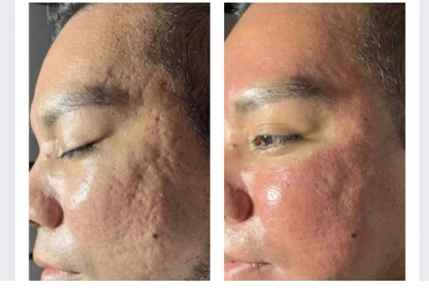 Procell Treatment
