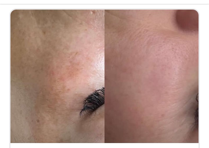 Salmon Facial