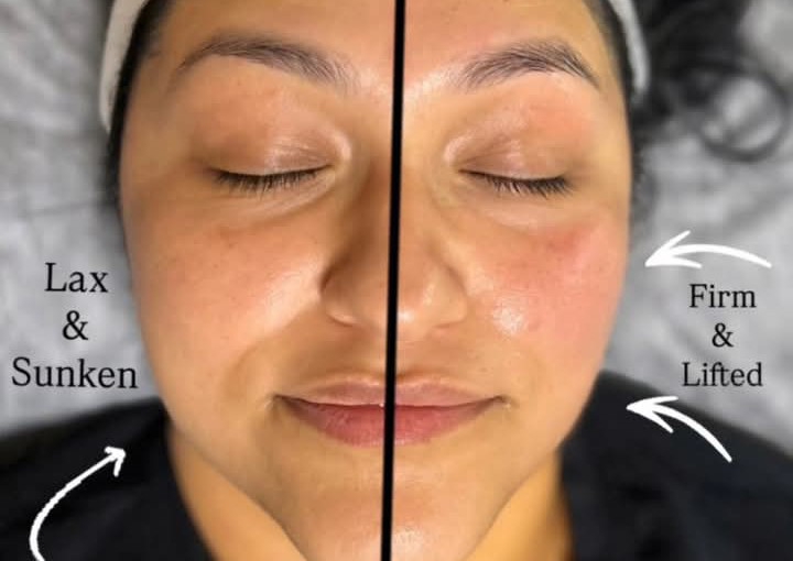 Radio Frequency Facial