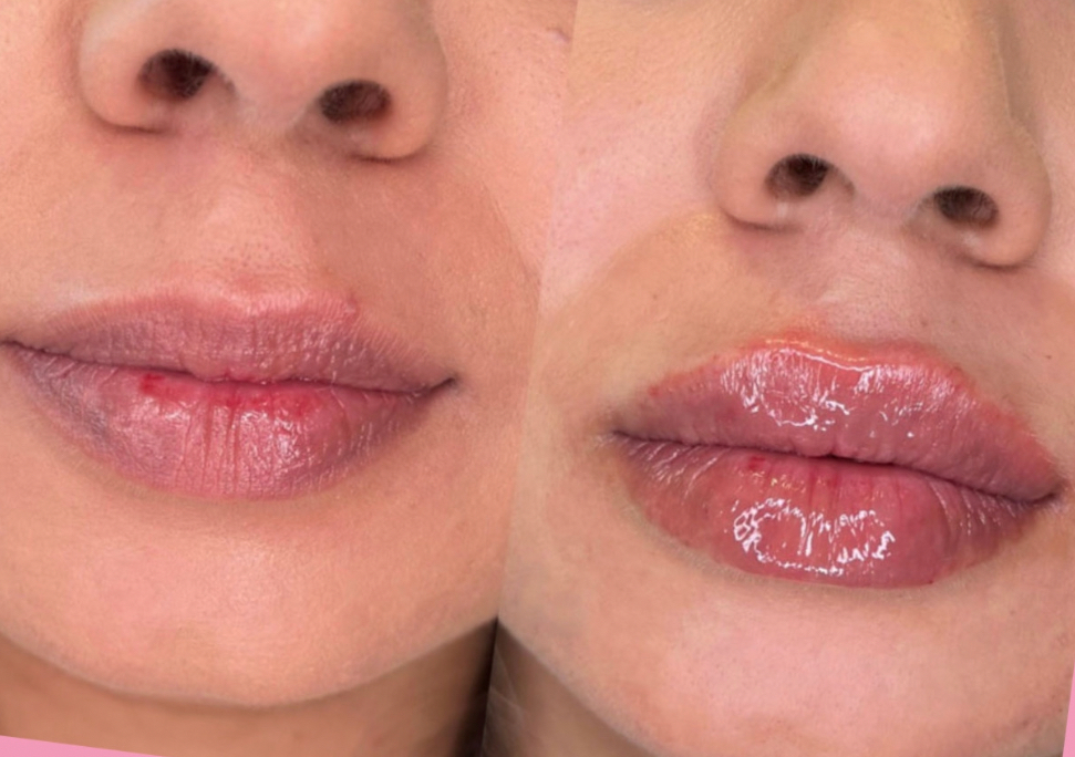 Micro Needle Lip Filler