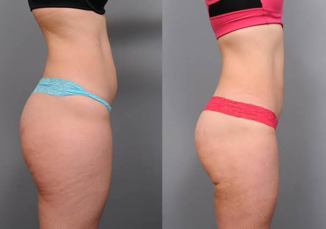 Laser Liposuction