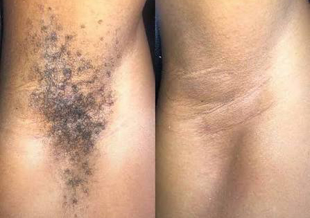 Underarm Wax