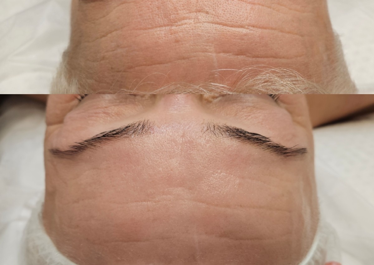 TA skaistinanti antiage procedūra